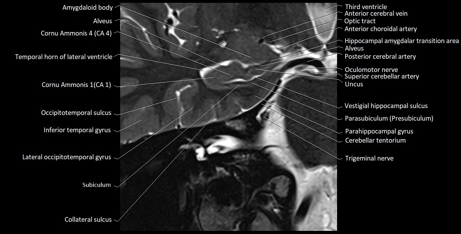 Hippocampus anatomy mri coronal cross section 3T MRI image 3.webp